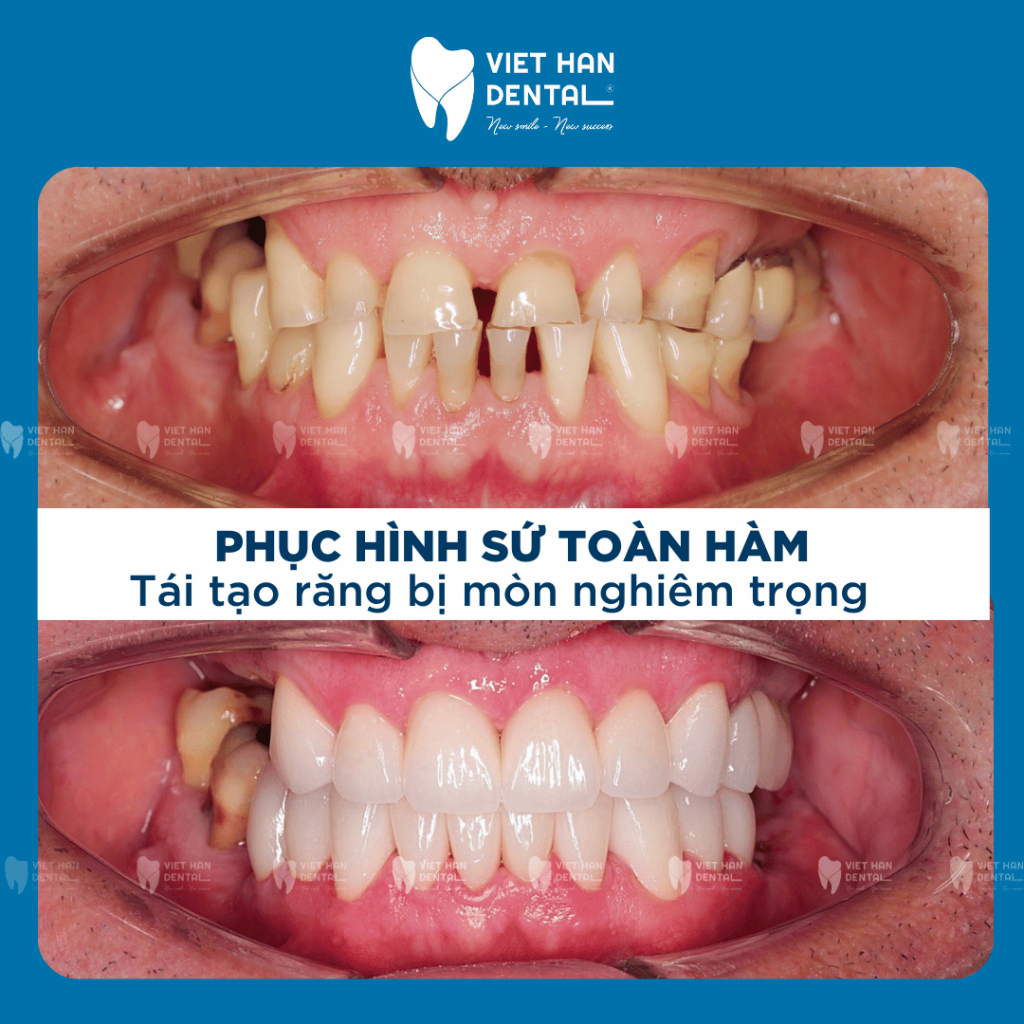 Hình ảnh khách hàng trước - sau khi phục hình răng sứ tại Nha khoa Việt Hàn Nha Trang