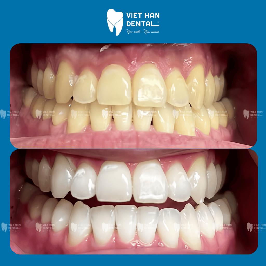 Hình ảnh khách hàng trước - sau khi tẩy trắng răng tại Nha khoa Việt Hàn Nha Trang