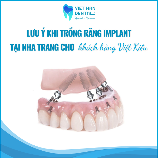 Lưu ý khi trồng răng Implant tại Nha Trang khách hàng Việt Kiều nhất định phải biết