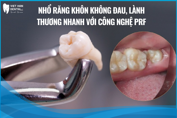 Nhổ răng khôn không đau, lành thương nhanh với công nghệ PRF