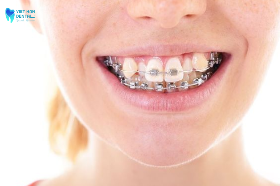 Niềng răng tăng trưởng mang đến hiệu quả dài lâu, hạn chế khó chịu