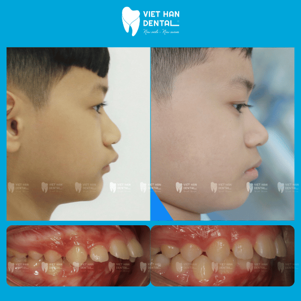 Trẻ niềng răng tăng trưởng hiệu quả tại Nha khoa Việt Hàn