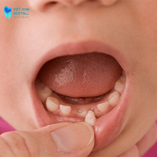 4Niềng răng cho con khi rụng răng sữa quá sớm hoặc quá muộn