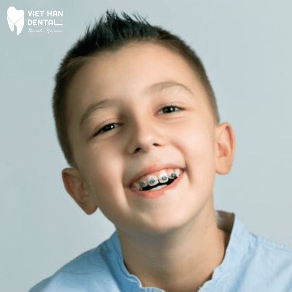Niềng răng cho con giai đoạn 1: Từ 7-9 tuổi