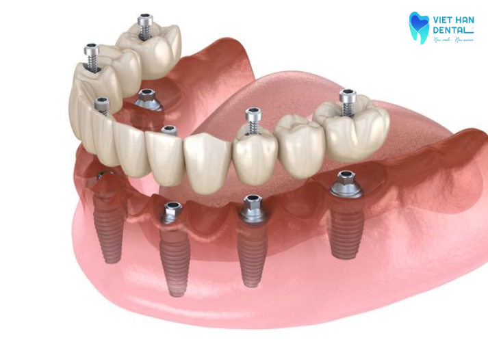 Trồng răng implant all onn 6