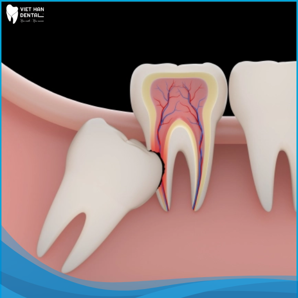 Nguy cơ có thể xảy ra khi nhổ răng khôn mọc lệch