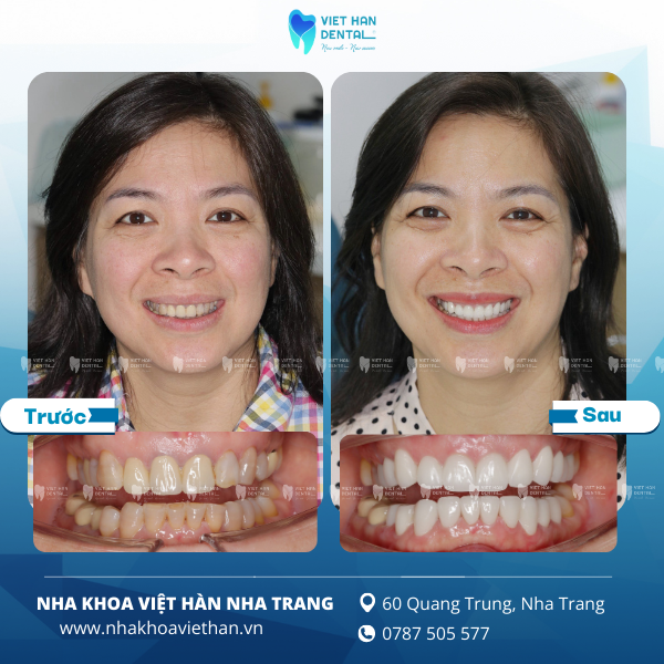 Khách hàng bọc răng sứ tại Nha khoa Việt Hàn