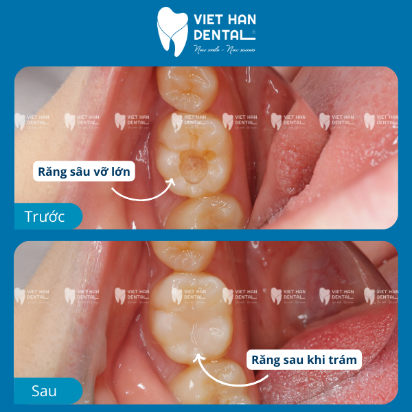 Hình ảnh trước và sau khi trám răng