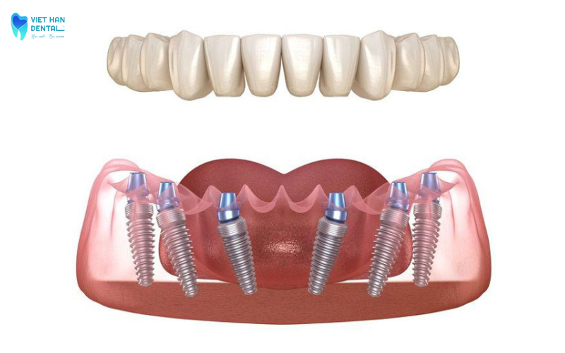 Mô phỏng hàm răng trồng răng Implant All-on-6