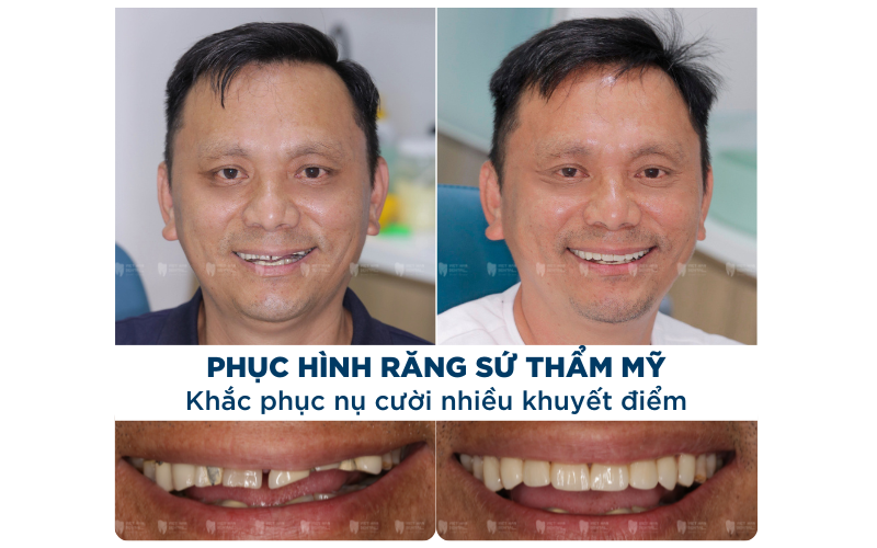 Khách hàng làm răng sứ tại Nha khoa Việt Hàn