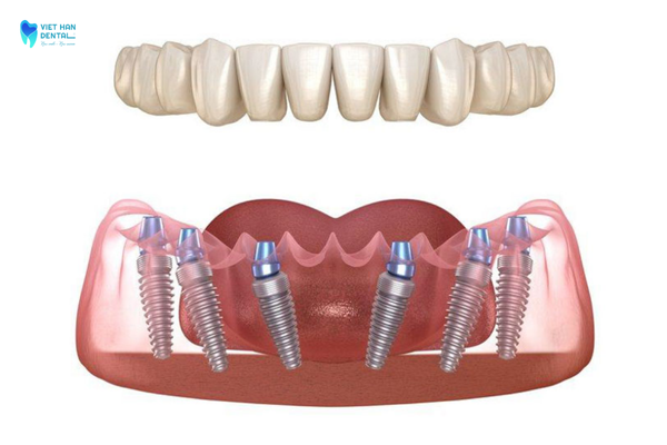 Cấy ghép Implant All on 6 hạn chế ghép xương ở mức tối thiểu