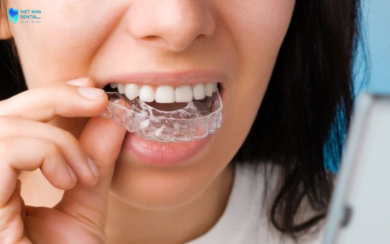 Răng số 8 cũng thường được Bác sĩ chỉ định nhổ khi niềng răng Invisalign