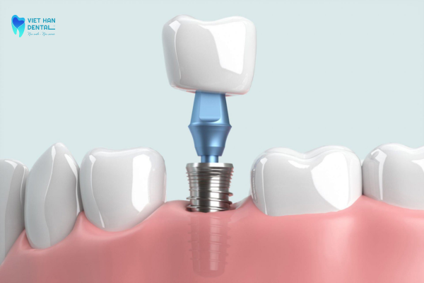 Cấy ghép trụ Implant an toàn, hiệu quả