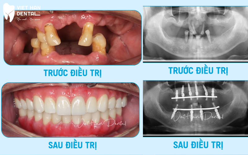 trồng răng Implant