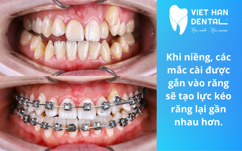 Mất răng hàm có niềng được không?