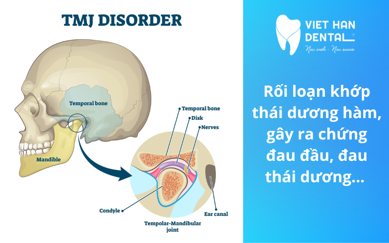 Nguyên nhân mất răng hàm? Hậu quả và cách khắc phục