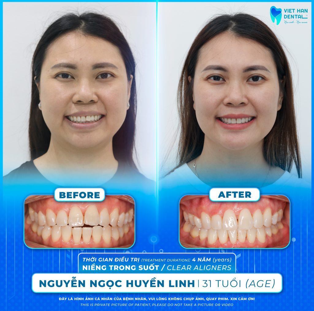 Khách hàng trước và sau khi niềng răng Invisalign tại Nha khoa Việt Hàn