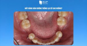 Mất răng hàm không trồng lại có sao không?