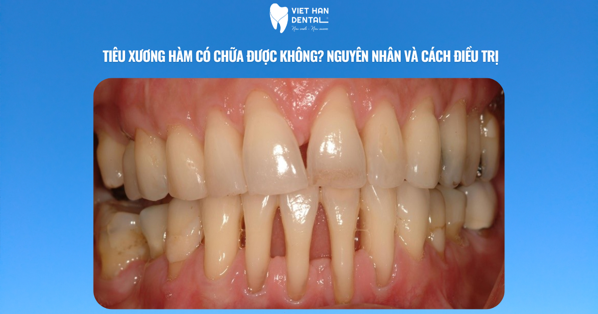 Tiêu xương hàm có chữa được không? Nguyên nhân và cách điều trị