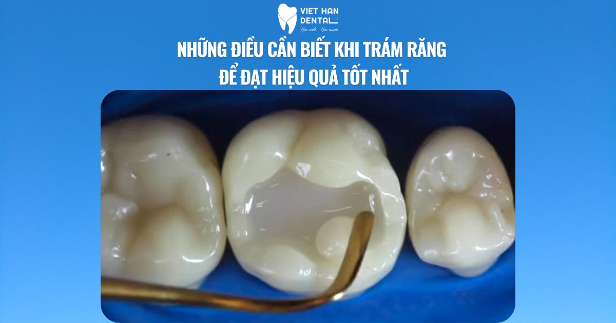 Những điều cần biết khi trám răng để đạt hiệu quả tốt nhất