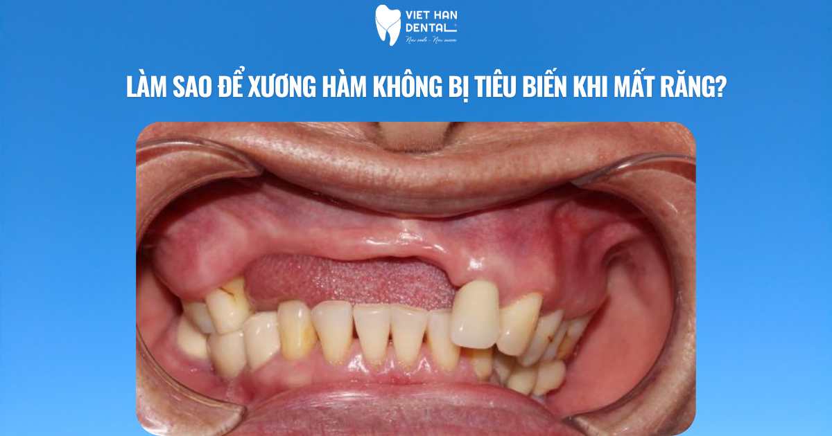 Làm sao để xương hàm không bị tiêu biến khi mất răng?