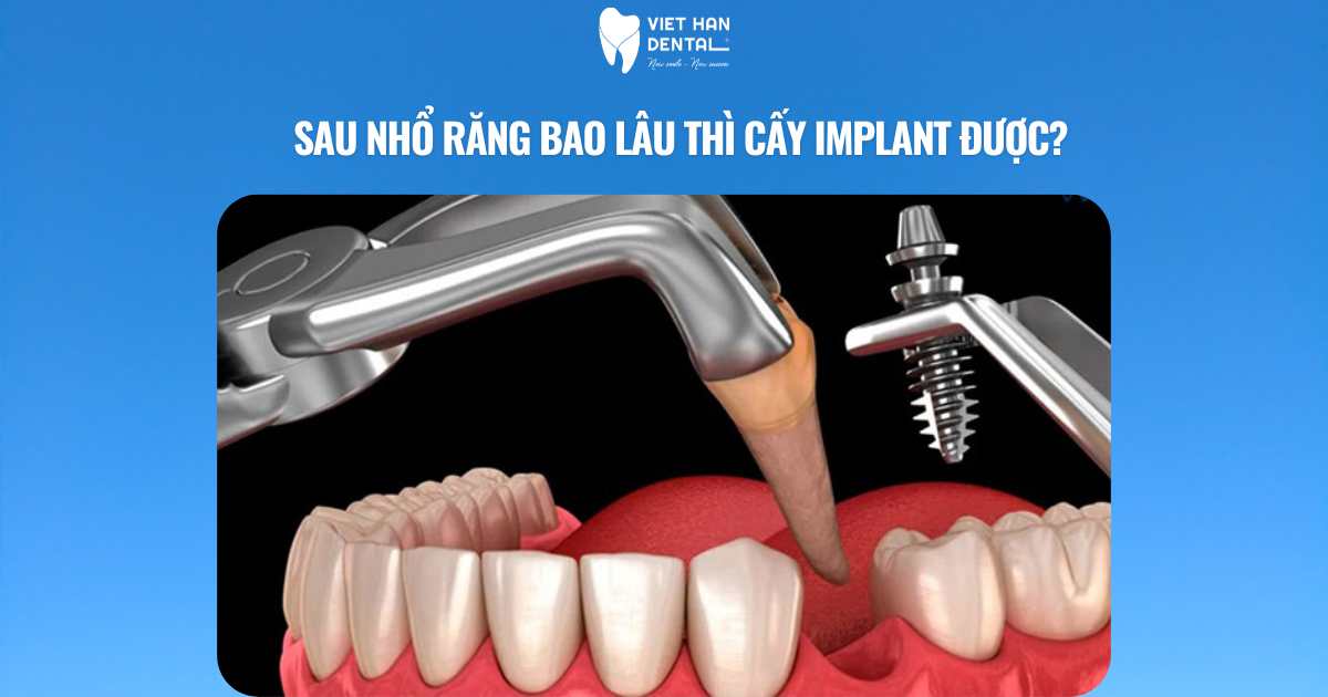 Sau nhổ răng bao lâu thì cấy implant được?