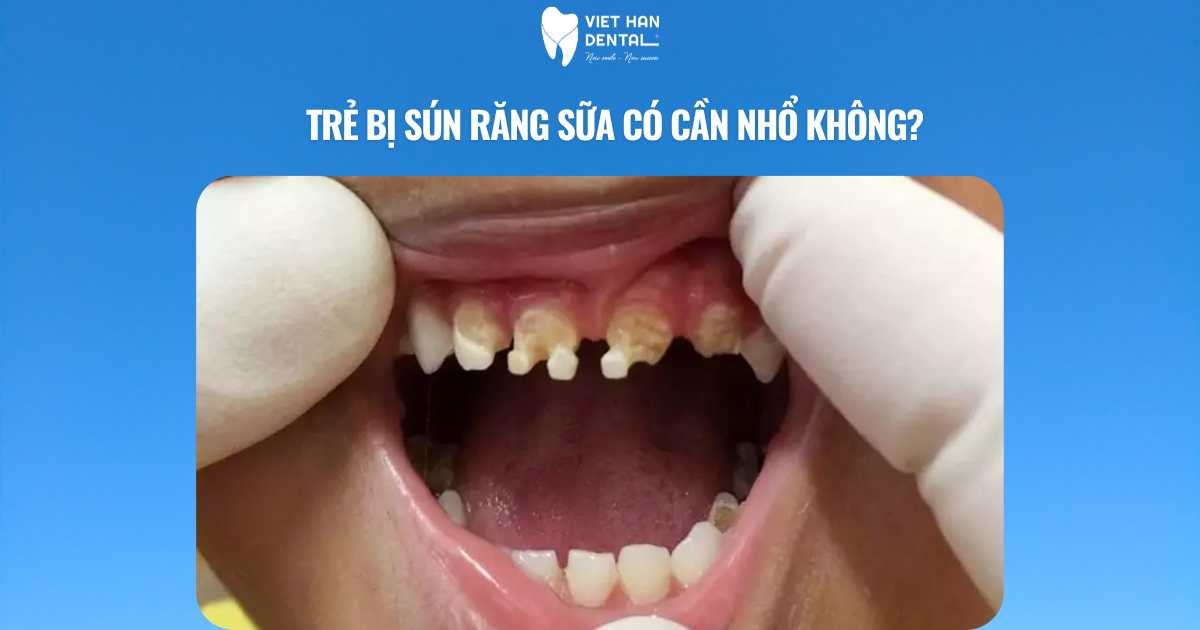 Trẻ bị sún răng sữa có cần nhổ không?