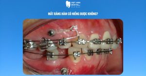 Mất răng hàm có niềng được không?