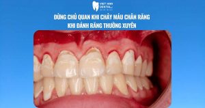 Đừng chủ quan khi chảy máu chân răng khi đánh răng thường xuyên