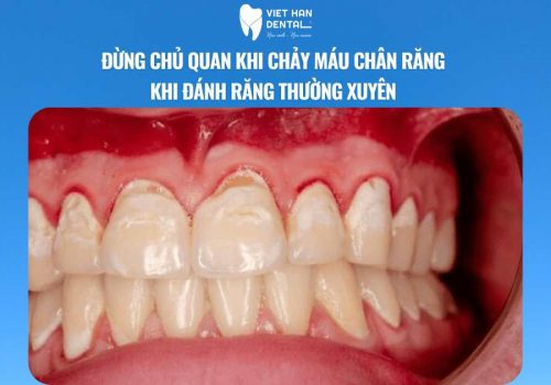 Đừng chủ quan khi chảy máu chân răng khi đánh răng thường xuyên