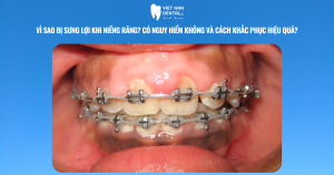 Vì sao bị sưng lợi khi niềng răng? Có nguy hiểm không và cách khắc phục hiệu quả?