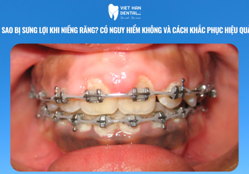 Vì sao bị sưng lợi khi niềng răng? Có nguy hiểm không và cách khắc phục hiệu quả?