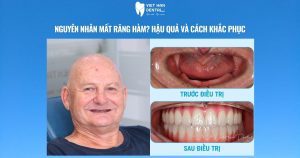 Nguyên nhân mất răng hàm? Hậu quả và cách khắc phục