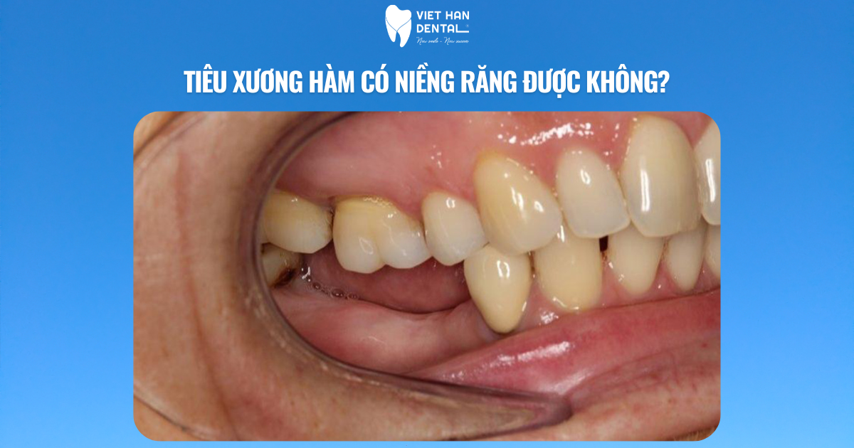 Tiêu xương hàm có niềng răng được không?