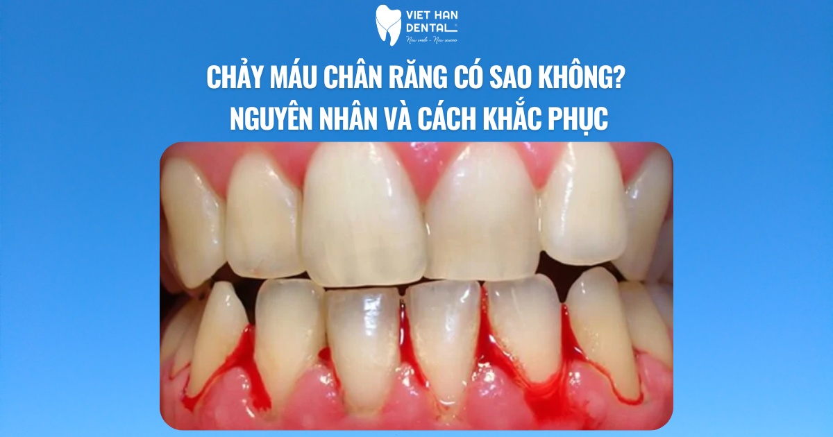 Chảy máu chân răng có sao không? Nguyên nhân và cách khắc phục