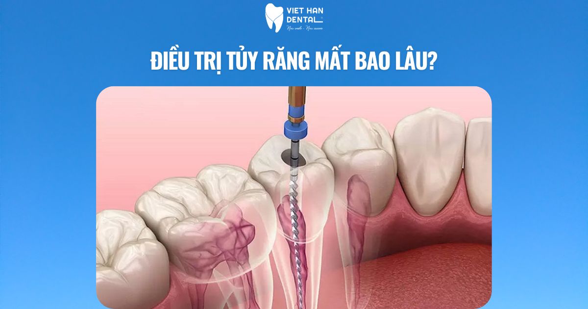 Điều trị tủy răng mất bao lâu?