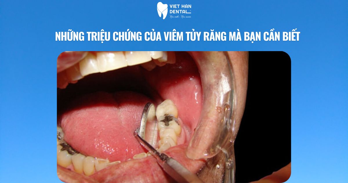 Những triệu chứng của viêm tủy răng mà bạn cần biết