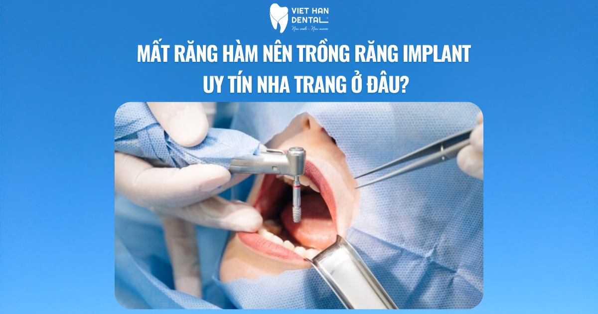 Mất răng hàm nên trồng răng Implant uy tín Nha Trang ở đâu?