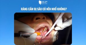 Răng cấm bị sâu có nên nhổ không?