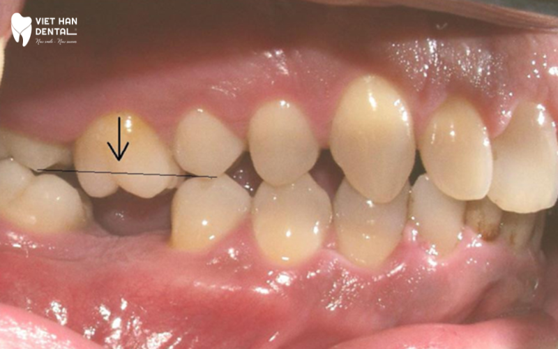 Tác hại của việc mất răng lâu năm 