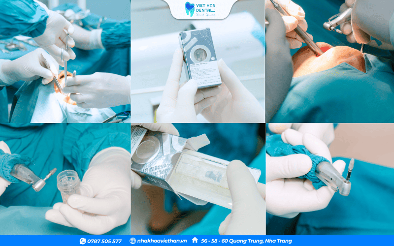 Trụ Implant được cấy trực tiếp vào xương hàm