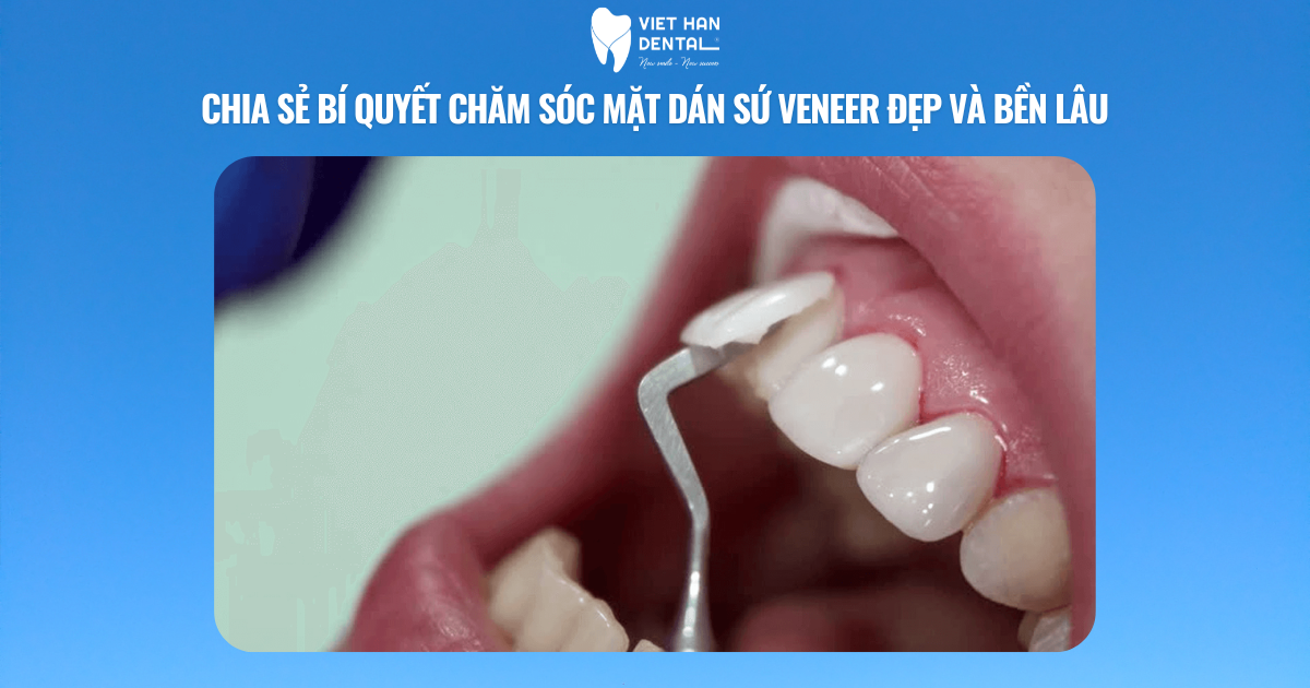 Chia sẻ bí quyết chăm sóc mặt dán sứ veneer đẹp và bền lâu