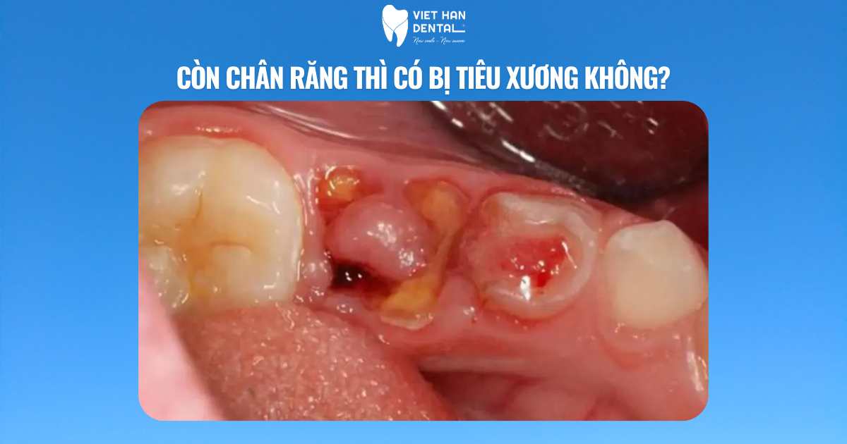 Còn chân răng thì có bị tiêu xương không?