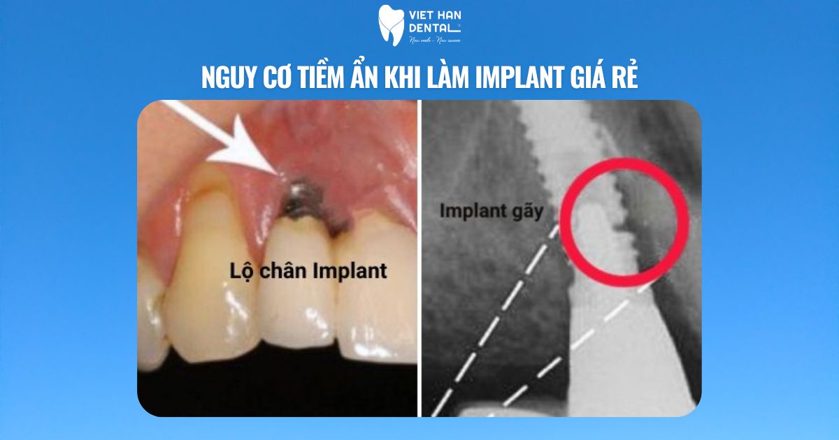 Nguy cơ tiềm ẩn khi làm implant giá rẻ