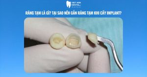 Răng tạm là gì? Tại sao nên gắn răng tạm khi cấy implant?