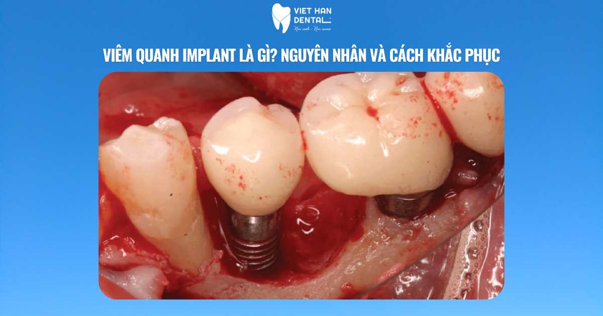 Viêm quanh implant là gì? Nguyên nhân và cách khắc phục