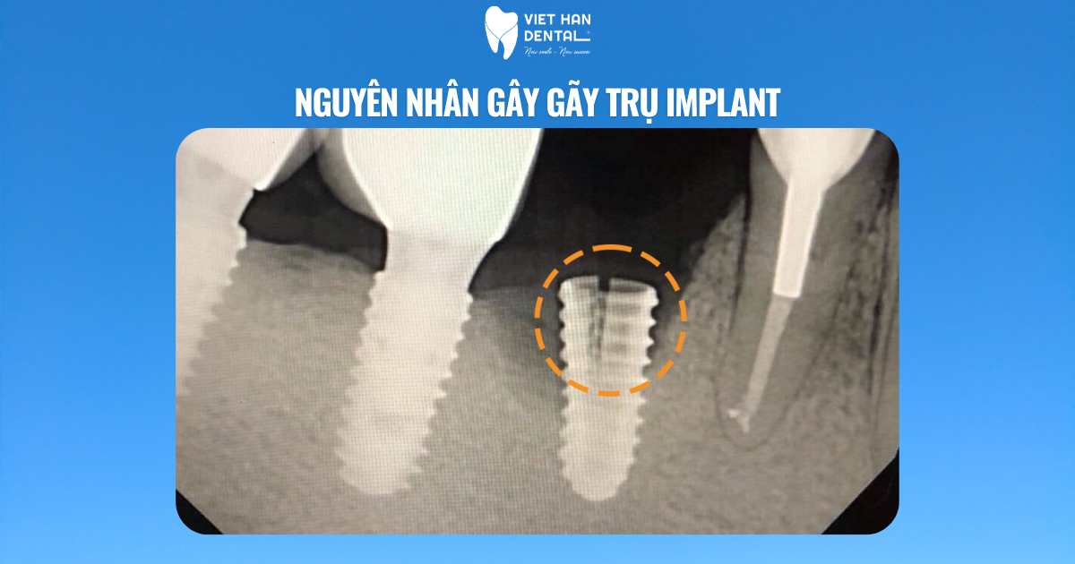 Nguyên nhân gây gãy trụ implant