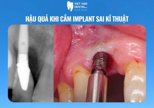 Hậu quả khi cắm implant sai kĩ thuật