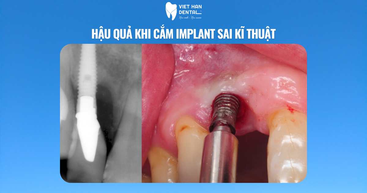 Hậu quả khi cắm implant sai kĩ thuật