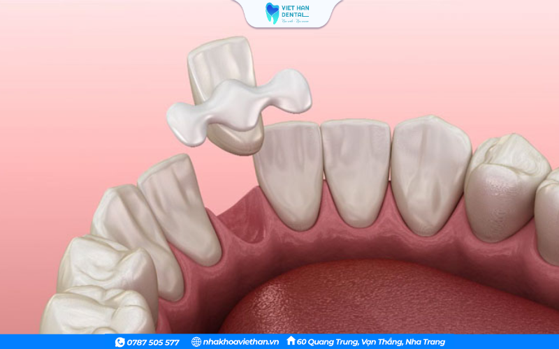 Răng tạm trên Implant